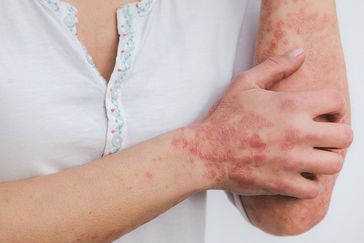 La crisis también impacta en la Psoriasis: 4 de cada 10 pacientes suspenden consultas por motivos económicos